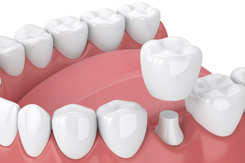 Dental Crowns in Childersburg / Inverness