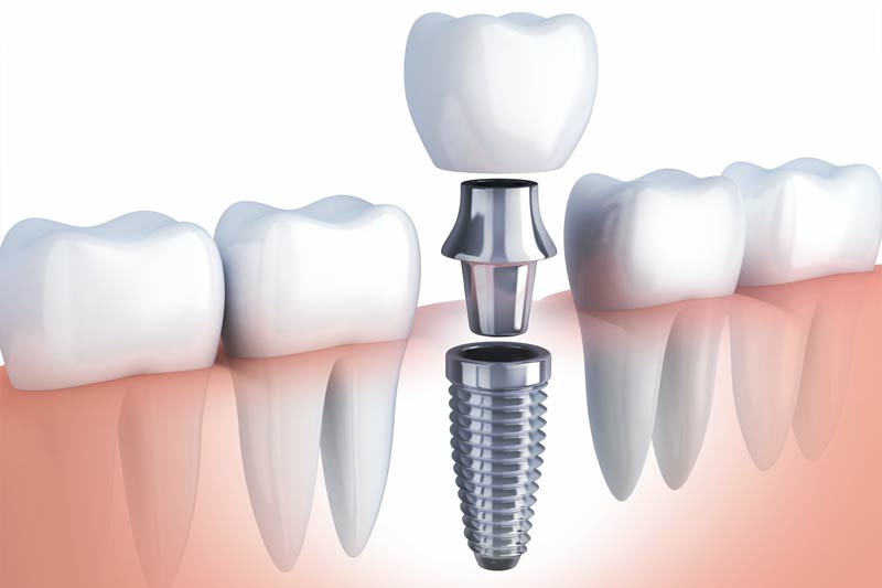 Implants Dentist in Childersburg / Inverness