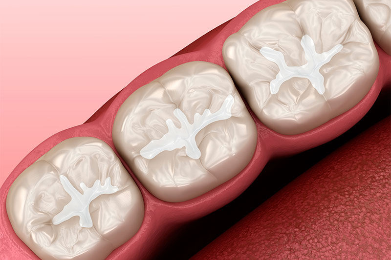 Dental Bonding in Childersburg / Inverness