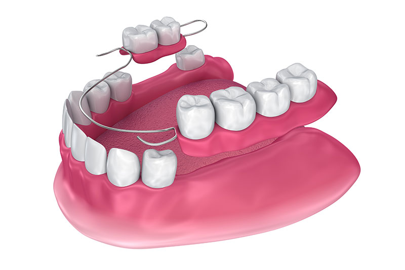 Partial Dentures in Childersburg / Inverness