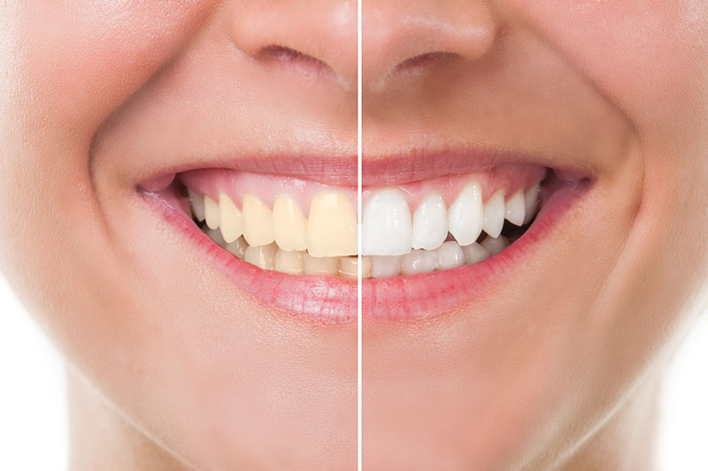 Teeth Whitening in Childersburg / Inverness