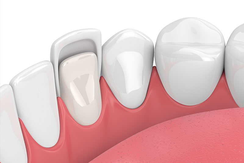 Porcelain Veneers in Childersburg / Inverness