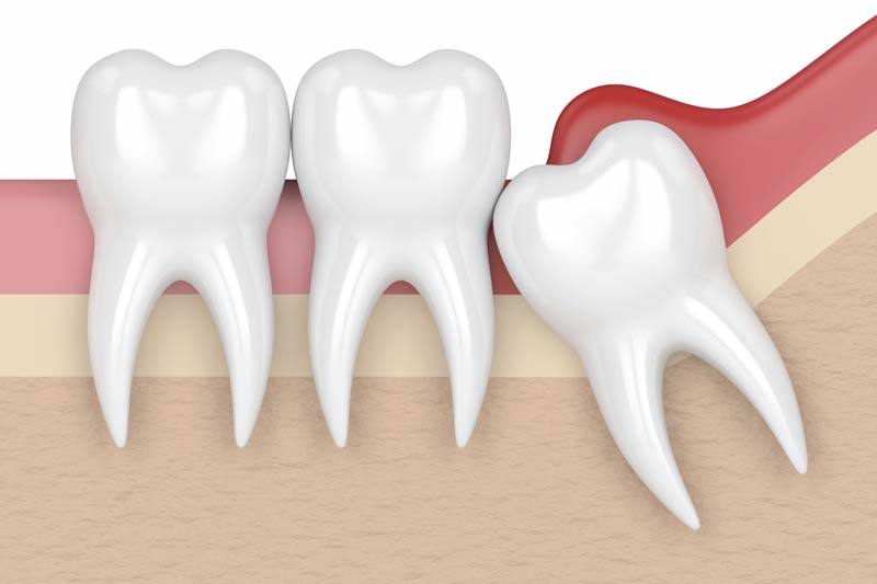 Wisdom Tooth Removal in Childersburg / Inverness